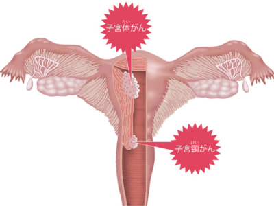 女性生殖器の病気の仕組み（子宮内膜症／子宮筋腫／子宮がん）
