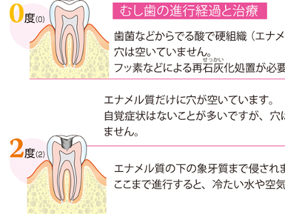 むし歯と歯周病の仕組み