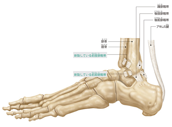 図解-捻挫