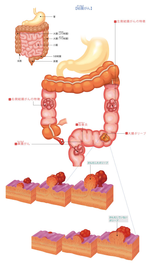 図解-大腸の病気