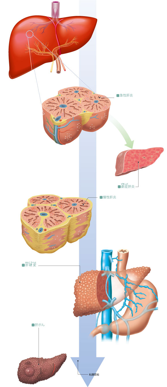 図解-肝臓の病気