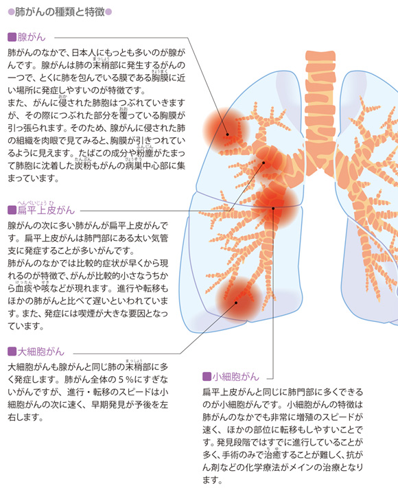 図解-肺がんの種類と特徴