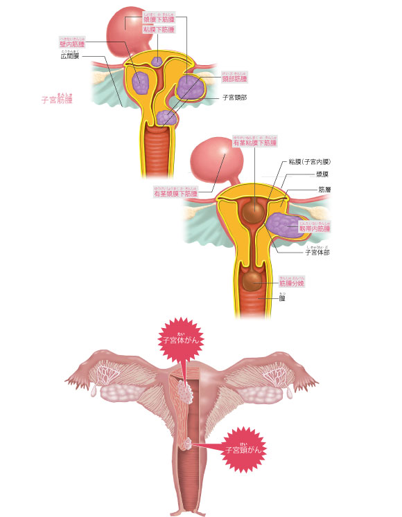 図解-子宮筋腫/子宮体がん/子宮頸がん