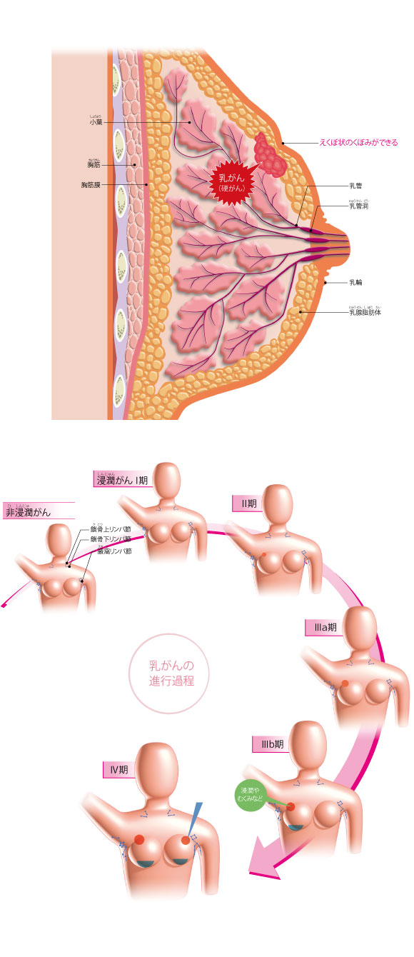 図解-乳がん