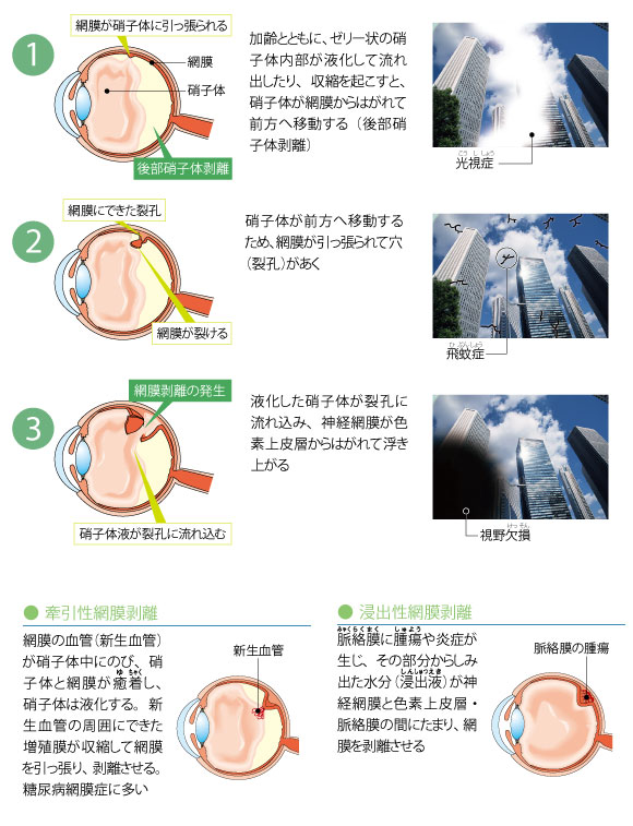 図解-網膜剥離